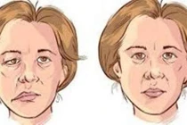 Mồi ngải chữa liệt dây thần kinh VII ngoại biên