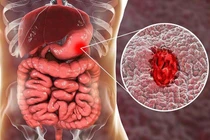 Chảy máu dạ dày vì ăn vặt