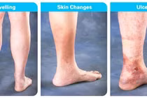 Trên 60 tuổi dễ hình thành cục máu đông