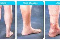 Trên 60 tuổi dễ hình thành cục máu đông