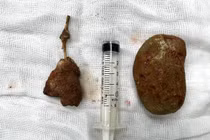 Cấp cứu vì sỏi khổng lồ bám quanh ông thông niệu quản bỏ quên 5 năm