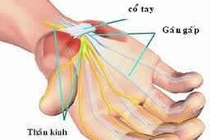 Hội chứng đường hầm cổ tay