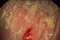 Tiêu chảy cẩn thận ung thư carcinoid đặc biệt nguy hiểm