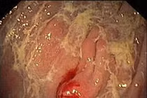 Tiêu chảy cẩn thận ung thư carcinoid đặc biệt nguy hiểm