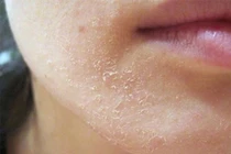 Trời lạnh da khô mốc, nứt nẻ