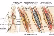 Can thiệp động mạch vành