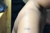 Học sinh trường quốc tế bị cô giáo đánh tím tay