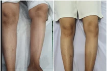 Hai chân không bằng nhau gây biến dạng cột sống