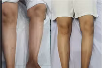 Hai chân không bằng nhau gây biến dạng cột sống