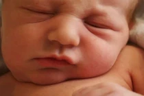 Phục hồi chức năng cho trẻ bị vẹo cổ bẩm sinh