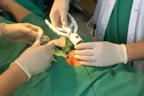 Ung thư vì chủ quan với chít hẹp bao quy đầu