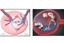 Phẫu thuật điều trị hội chứng truyền máu song thai