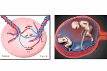 Phẫu thuật điều trị hội chứng truyền máu song thai