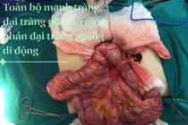 Xoắn ruột do ruột quay bất toàn