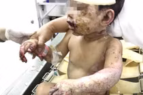 Đề phòng các tai nạn liên quan đến bỏng 