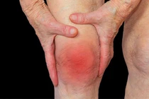 Nên xét nghiệm axit uric định kỳ để tránh gút cấp