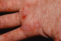 Người trưởng thành vẫn có thể mắc bệnh tay chân miệng 