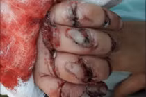 Bé 2 tuổi suýt đứt rời các ngón tay vì kẹt vào dây cu-roa