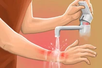 Bỏng nồi cơm điện