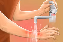 Bỏng nồi cơm điện