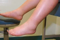 Phù chân do bệnh mạch máu?