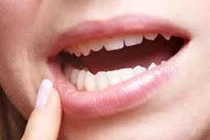 Nổi cục thịt dưới nướu