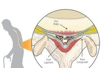 Nguyên nhân gây hẹp ống sống thắt lưng tiến triển