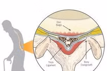 Nguyên nhân gây hẹp ống sống thắt lưng tiến triển