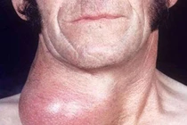 Điều trị basedow bằng thuốc