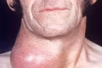 Điều trị basedow bằng thuốc