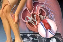 Thay đổi lối sống tránh tắc động mạch.