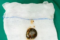 Nuốt pin cúc áo, bé trai bị bỏng hóa chất gây chít hẹp thực quản