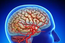 Điều trị túi phình động mạch não