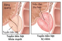 Viêm tuyến tiền liệt giảm khả năng sinh sản