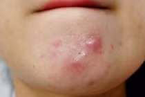 Chữa mụn nhọt bằng thuốc Nam