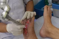 Khi nào phải chỉ định cắt cụt chi do đái tháo đường