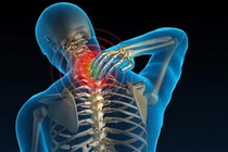 Điều trị thoái hóa đốt sống cổ lâu khỏi