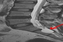  Các triệu chứng của nang Tarlov