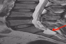  Các triệu chứng của nang Tarlov