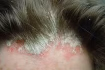 Tóc rụng, da đầu sần đỏ