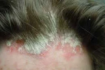 Tóc rụng, da đầu sần đỏ