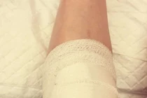 Gãy chân vì đi xe nghe nhạc