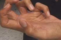 Rối loạn vận động co rút kiểu nhà văn