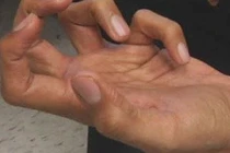 Rối loạn vận động co rút kiểu nhà văn