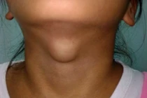 3 cách điều trị bướu giáp basedow