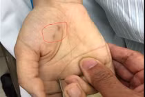 Bị chó ốm cắn vào tay, nữ bác sĩ thú y trẻ tuổi tử vong vì bệnh dại