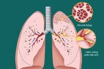 Fibrolysin – Hướng điều trị mới mang lại hiệu quả cao và an toàn cho các bệnh viêm đường hô hấp