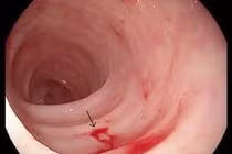 Những người hay bị chảy máu dạ dày 