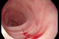 Những người hay bị chảy máu dạ dày 