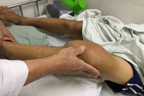 Tại sao người bệnh gout sợ bia hơn rượu?